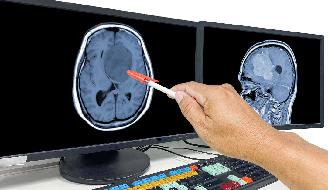 Clatterbridge leads the way in ground-breaking brain cancer research thumbnail image