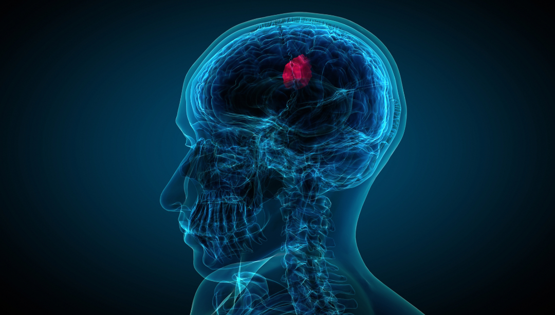 Brain tumour 1.png