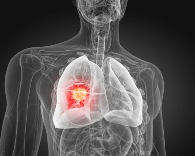 New cancer vaccine clinical research trial to open for Clatterbridge patients thumbnail image